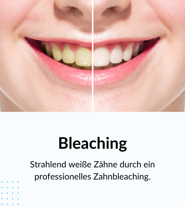 Zahnbleaching beim Zahnarzt in Leipzig